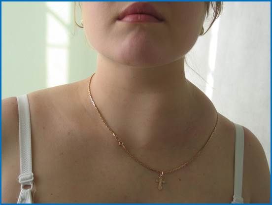 uvielichieniie_pierifierichieskikh_limfouzlov_html_m423e0493