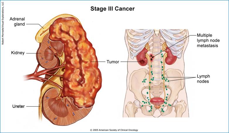 kidney_stage3_print