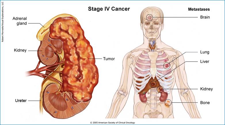 kidney_stage4_print