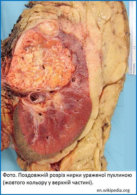 Kidney cancer