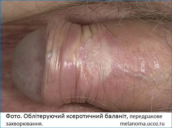 Облітеруючий ксеротичний баланіт
