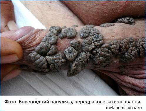 Бовеноїдний папульоз