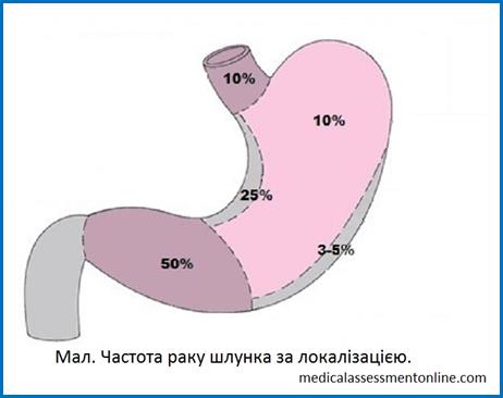 Stomach_Cancer_