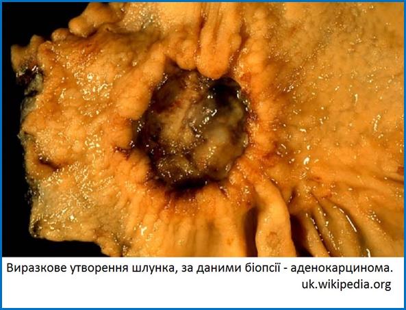 Adenocarcinoma_of_the_stomach