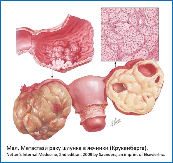 Крукенберг
