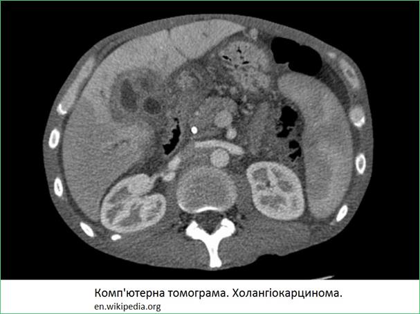 CT_cholangioca