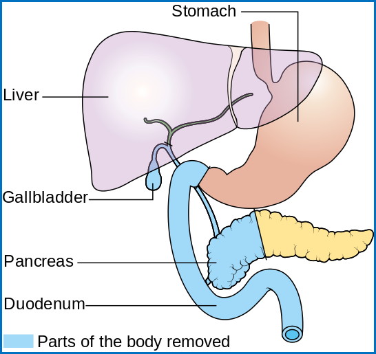 Diagram_showing_the_parts_removed_with_a_Whipple's_operation_CRUK_337.svg