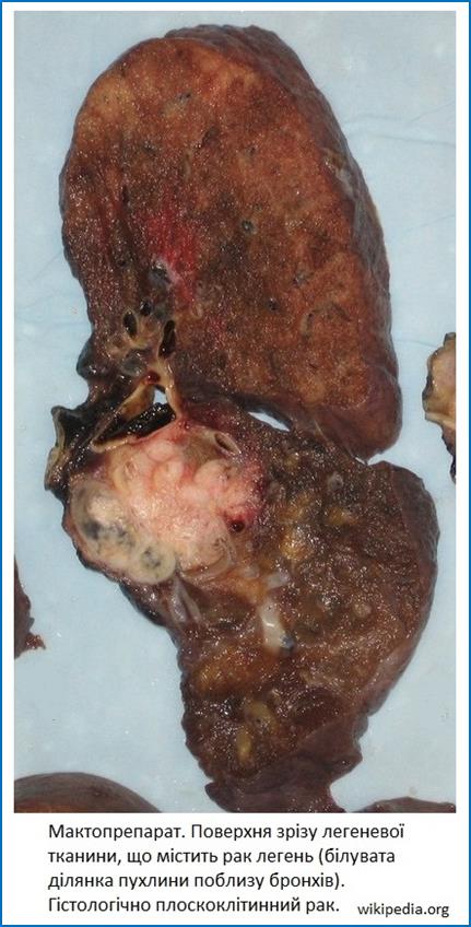 Lung cancer