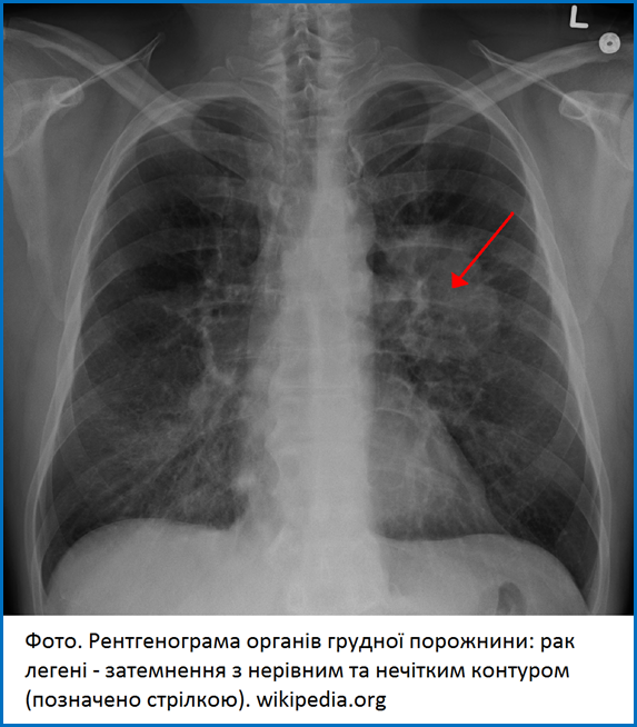 LungCACX