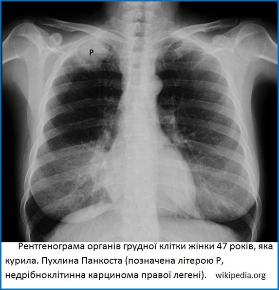 Pancoast_Tumor_1