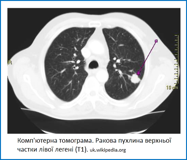 Thorax_CT_Brronchialcarcinom