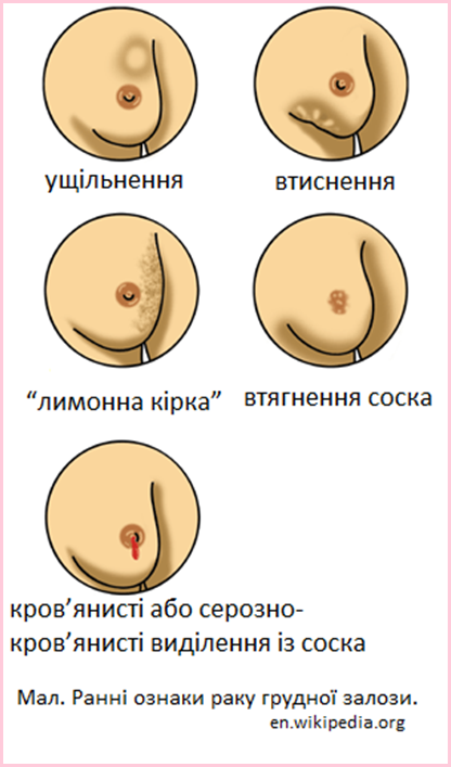 En_Breast_cancer_illustrations - копия