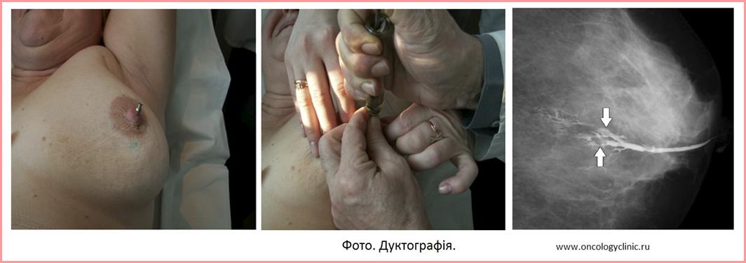 Дуктографія
