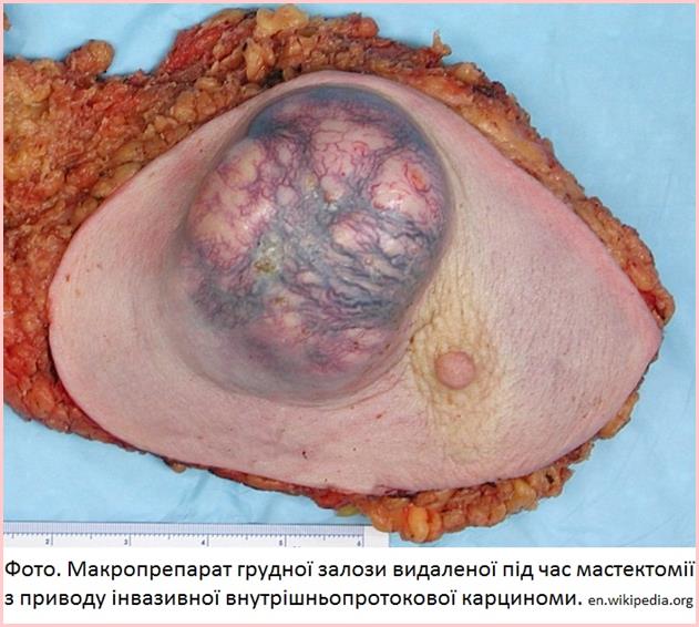 BreastCancer